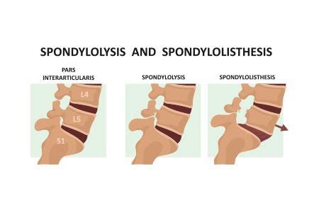 Spondylolysis and Spondylolisthesis: What is Spondylolysis, its Causes?