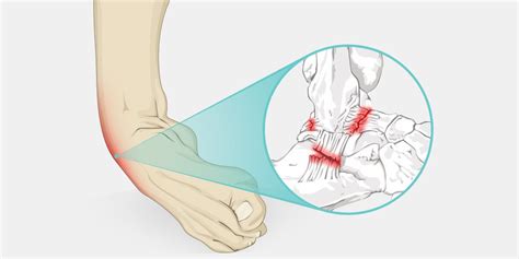 ANKLE INSTABILITY – Di Nallo Orthopaedics