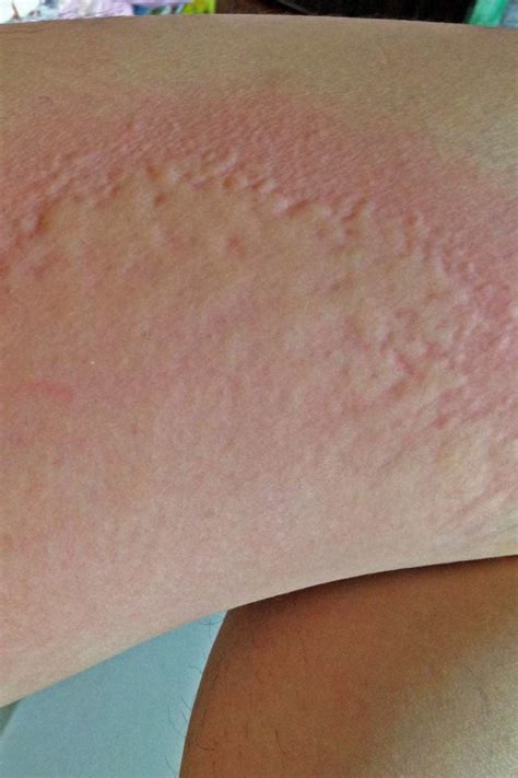 Is it a hepatitis C rash?