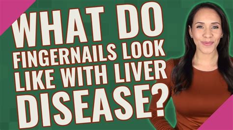 What do fingernails look like with liver disease? - YouTube