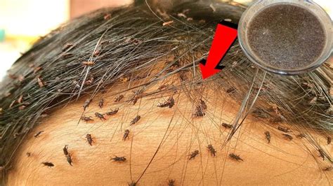 How to Remove lice eggs and lice in hair permanently | Lice eggs, Lice ...