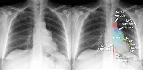 Chest X-ray - Mediastinum and hilum - Posterior mediastinal mass