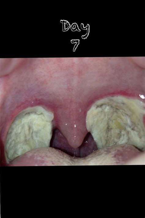 Tonsillectomy Scabs Fall Off 2019 | Tonsillectomy