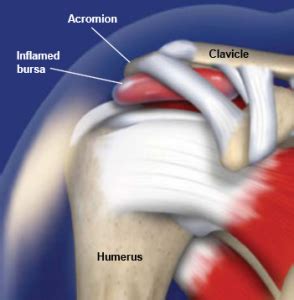 Subacromial Bursitis | Central Coast Orthopedic Medical Group