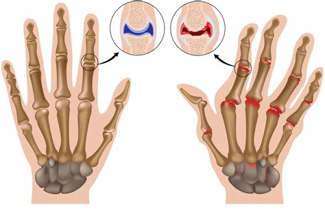 Hands – Arthritis « Oxford Orthopaedics