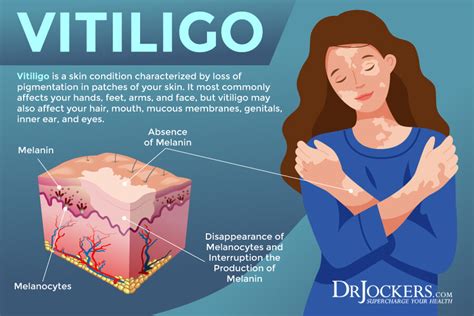 Vitiligo: Symptoms, Causes, and Support Strategies - DrJockers.com