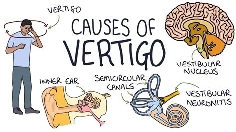 Vertigo is the sensation of feeling off-balance or dizzy