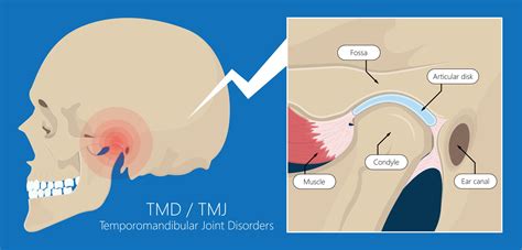 TMJ Treatments: Effective Solutions for Temporomandibular Joint Disorders