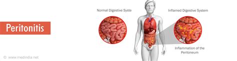 Peritonitis - Causes, Symptoms, Complications, Diagnosis, Treatment ...