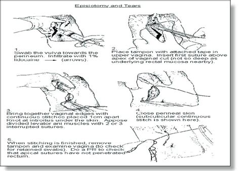 Steps of episiotomy procedure . | Download Scientific Diagram