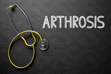 10 Lifestyle Changes for Managing Arthrosis Symptoms - Facty Health