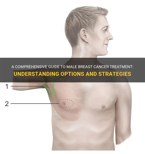 A Comprehensive Guide To Male Breast Cancer Treatment: Understanding ...