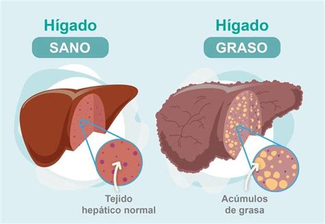 Que es el higado graso causas sintomas diagnostico y tratamiento