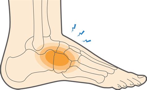 Jammed Toe Injury