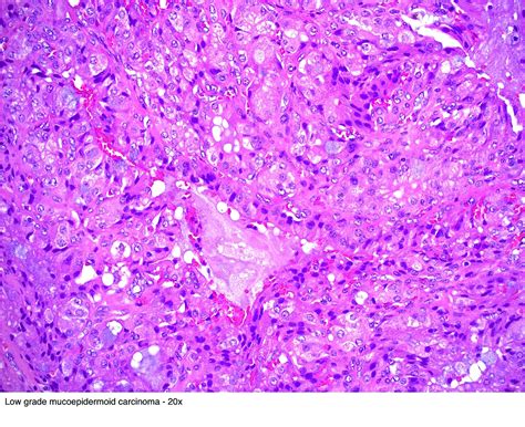 Pathology Outlines - Mucoepidermoid carcinoma