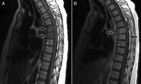 A) Non-contrast T1 magnetic resonance imaging (MRI) of thoracic ...