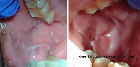 Diagnosing Oral & Maxillofacial Pathologies in My Residency: LINEA ALBA ...