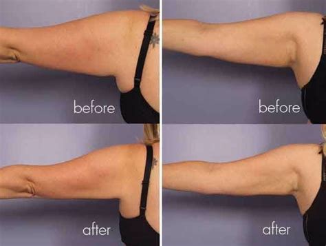 Slendertone Arms Before And After Photos