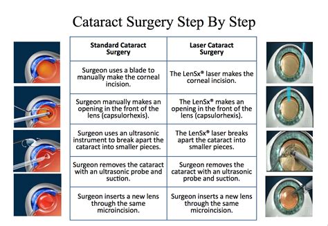 cataract surgery process - Gailey Eye Clinic