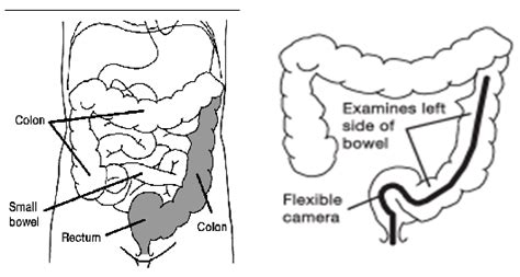 Sigmoidoscopy – endoscopic examination of the large intestine ...