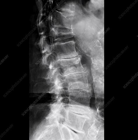 Lumbar Vertebrae X Ray