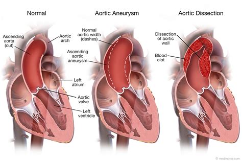 Aortic Aneurysm and Aortic Dissection – Medmovie.com