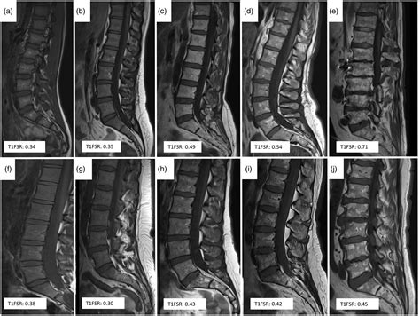 Correlation between fat signal ratio on T1-weighted MRI in the lower ...