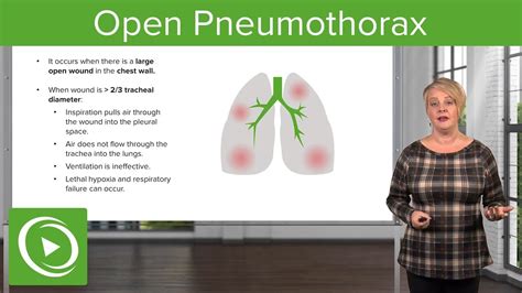 What Is The Pathophysiology Of Flail Chest? Quick Answer ...