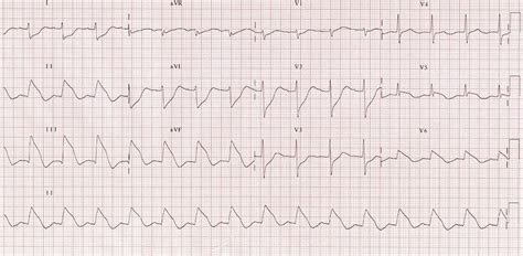 Inferior STEMI • LITFL • ECG Library Diagnosis