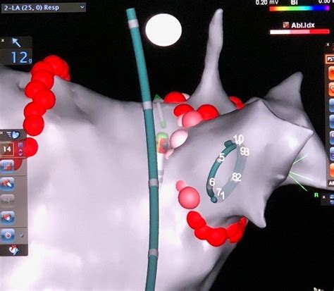 Esophageal Temp. Monitoring – Life Systems Medical