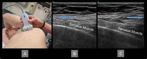 Serratus anterior plan block. (A) Patient and transducer positioning ...