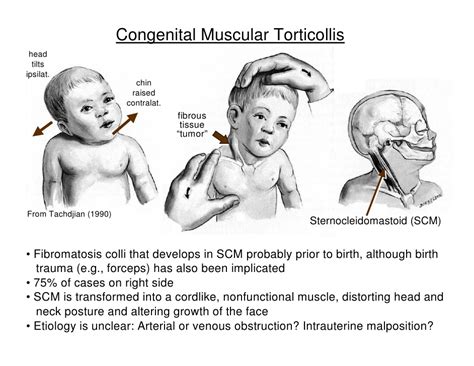 SAMARPAN PHYSIOTHERAPY CLINIC: Wryneck ( Torticollis ) : Physiotherapy ...