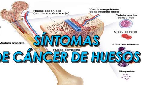 Cancer De Huesos Sintomas Iniciales - SEONegativo.com