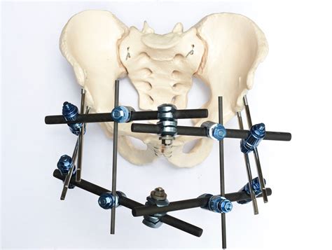 Pelvic Fracture Fixation