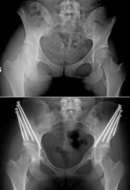 Periacetabular Osteotomy (PAO) for Acetabular Dysplasia - John C ...