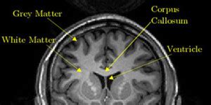 Grey Matter Brain Damage | White vs. Grey Matter Injury