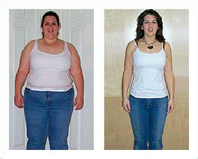 13 Ways Lap-Band Surgery Will Affect You - Bariatric Surgery Source