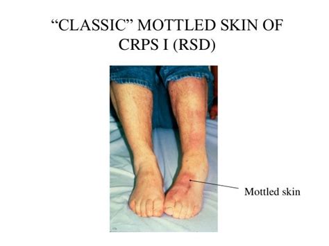 CRPS I (RSD) with pictures. Differential Diagnosis