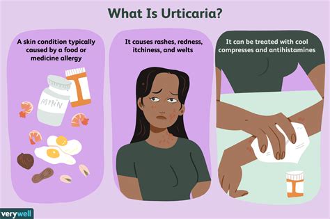 Urticaria (Hives): Overview and More