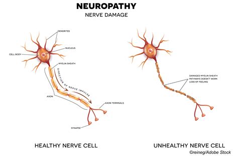 Small Fiber Neuropathy: Not So Rare Anymore? - Physician's Weekly