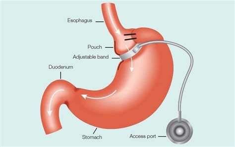 Adjustable gastric banding - IRAN Health Tourism Organizer - Iran ...