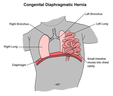 A Bochdalek hernia involves an opening on the left side of the ...