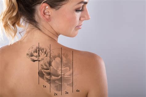 How Do I Find the Best Tattoo Removal Specialist Near Me? - Northern VA ...