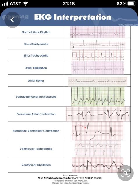 Printable Ekg Rhythms