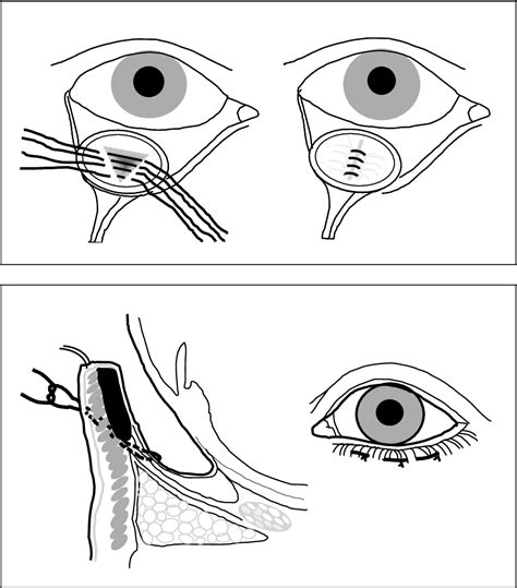 What Is Entropion Surgery