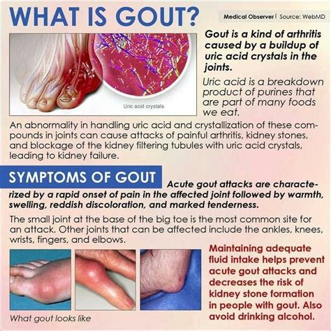 A little info for everyone about Gout and its symptoms. | Gout, Gout ...