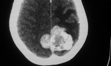 Daily Dose: Falx meningioma