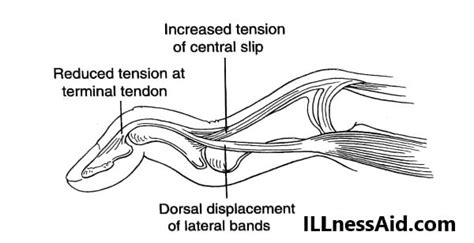 SWAN NECK DEFORMITY: CAUSES, TREATMENT - ILLnessAid