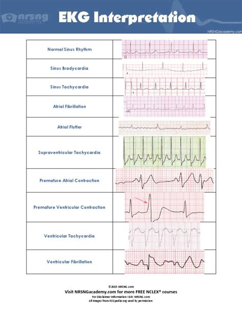 10 Common EKG Heart Rhythms.pdf