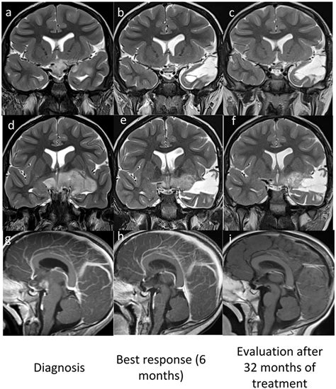 Frontiers | Vemurafenib Treatment of Pleomorphic Xanthoastrocytoma in a ...